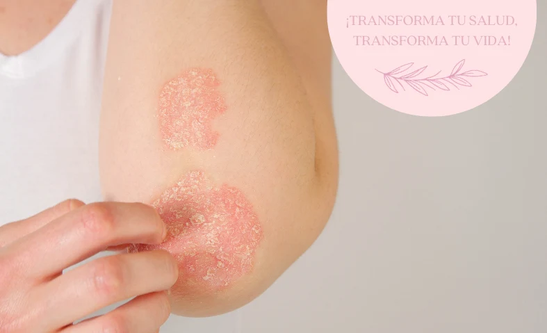Psoriasis y salud intestinal