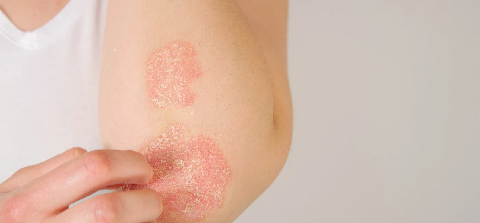 Psoriasis y salud intestinal